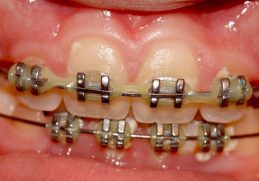 cost of teeth braces in Thailand